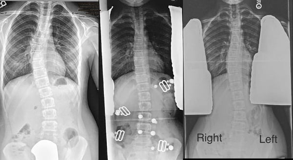 LA 3D Brace - LA Brace Center